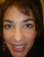 Geraldine Janzen Fernandine Beach Florida Advanced Laser Vision Surgery Pterygium blurred Vision 