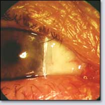 Large Pterygium