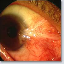 Large Pterygium