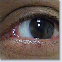 Small Pterygium