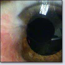 Small Pterygium