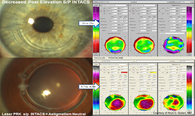 Intacs Enhancement