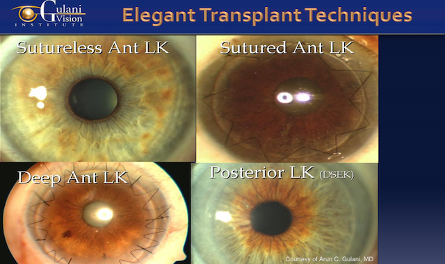 diagram of an eye with decreased keratometry