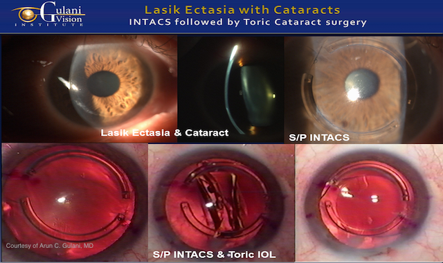 diagram of an eye with cataracts