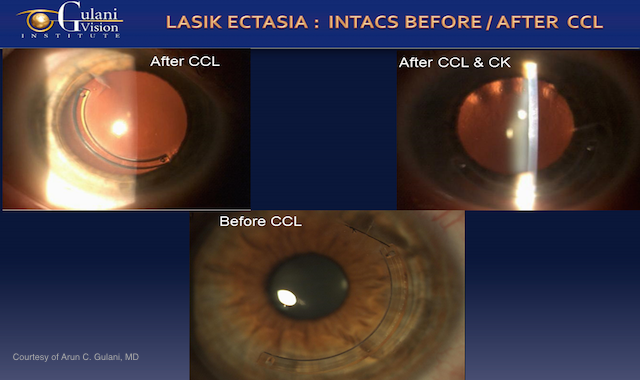 diagram of an eye before and after ccl