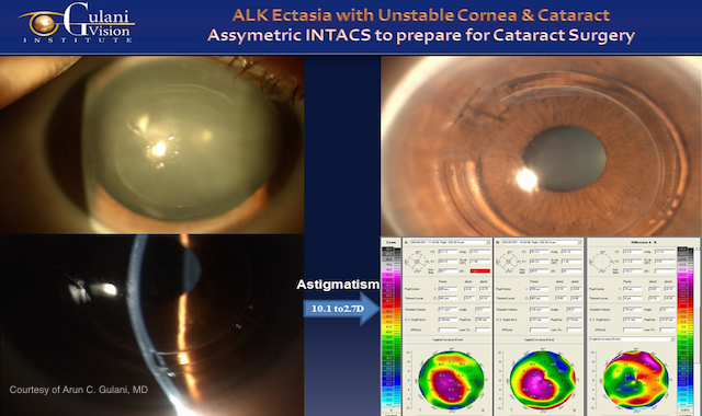 diagram of an eye before and after cataract surgery