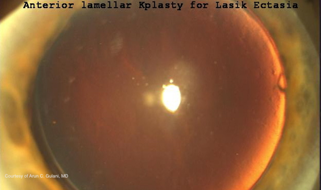 diagram of an eye with keratometry