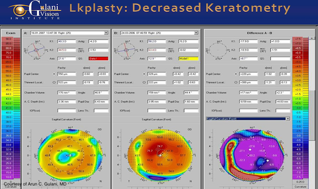 diagram of an eye with decreased keratometry