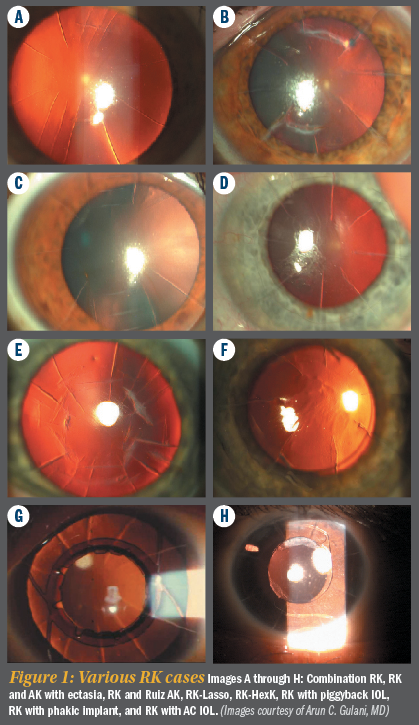 close up photo of an eye with blinding radial keratotomy scars