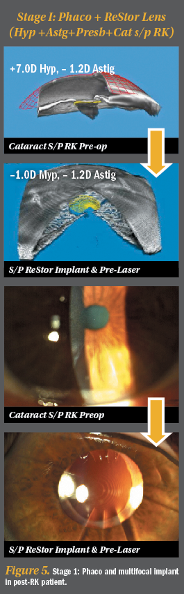 diagram of an eye with blinding radial keratotomy scars