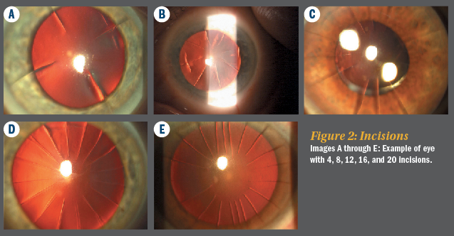 close up photo of an eye with blinding radial keratotomy scars