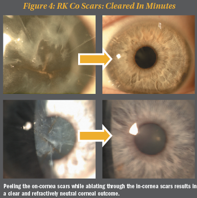 close up photo of an eye with blinding radial keratotomy scars