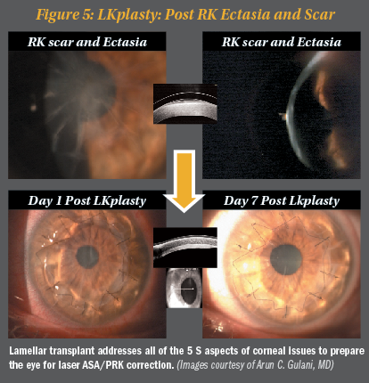 close up photo of an eye with blinding radial keratotomy scars