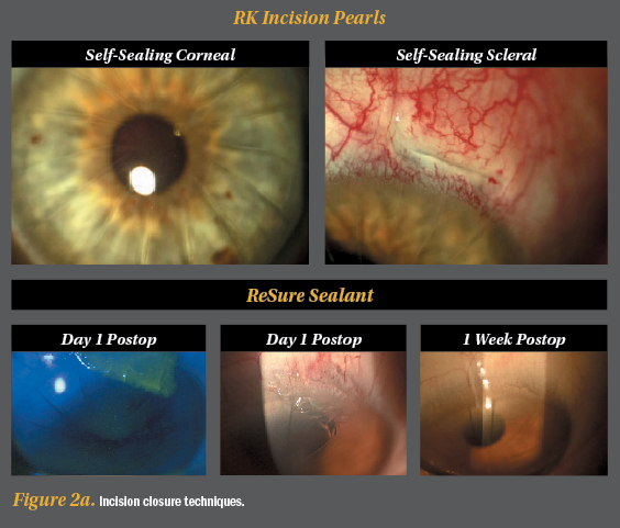 close up photo of an eye with blinding radial keratotomy scars