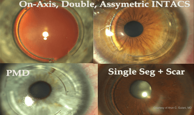 diagram of eyes with keratoconus