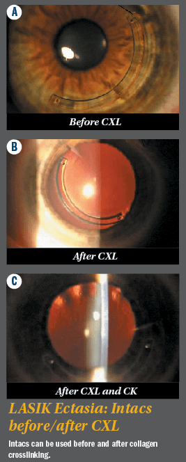 Before and After CXL