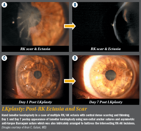 LKplasty: Post-RK Ectasia and Scar