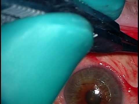 Conjunctivochalasis Eye Surgery 