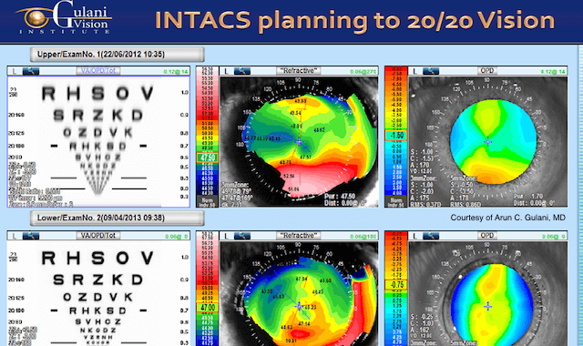 diagram of an eye before and after having perfect vision