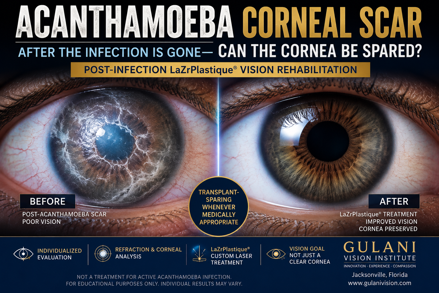 Acanthamoeba corneal scar after infection showing transplant-sparing LaZrPlastique vision rehabilitation by Dr. Arun Gulani