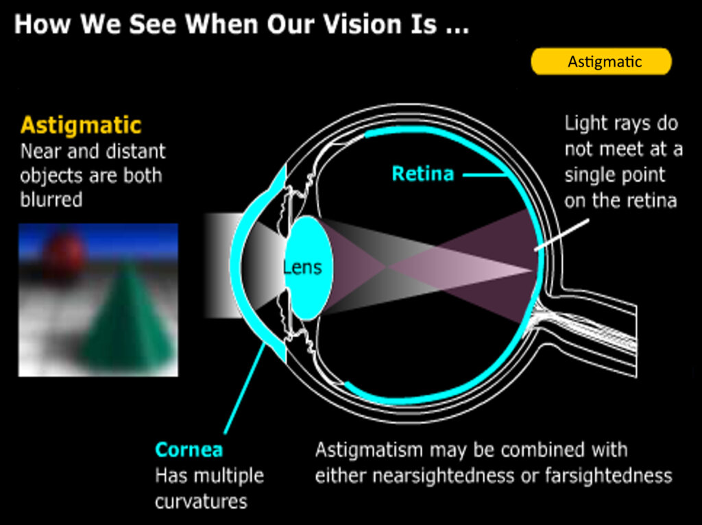 diagram of an eye with astigmatism 