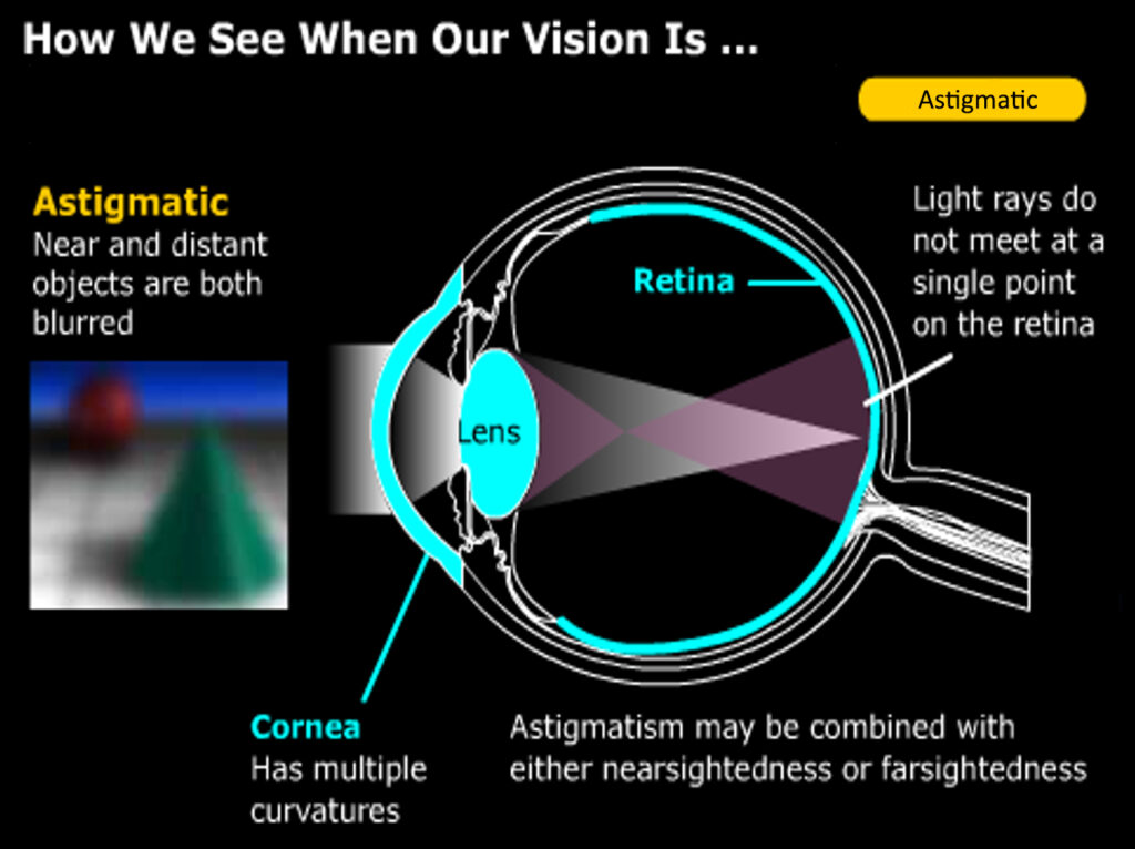 diagram of an eye with astigmatism