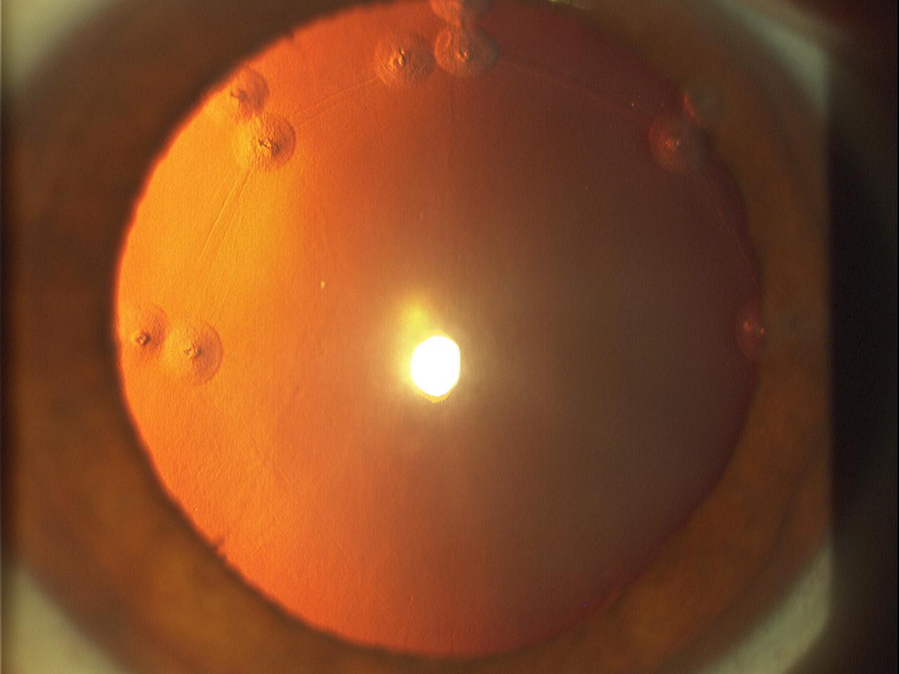 Fixing Conductive Keratoplasty (CK) Complication