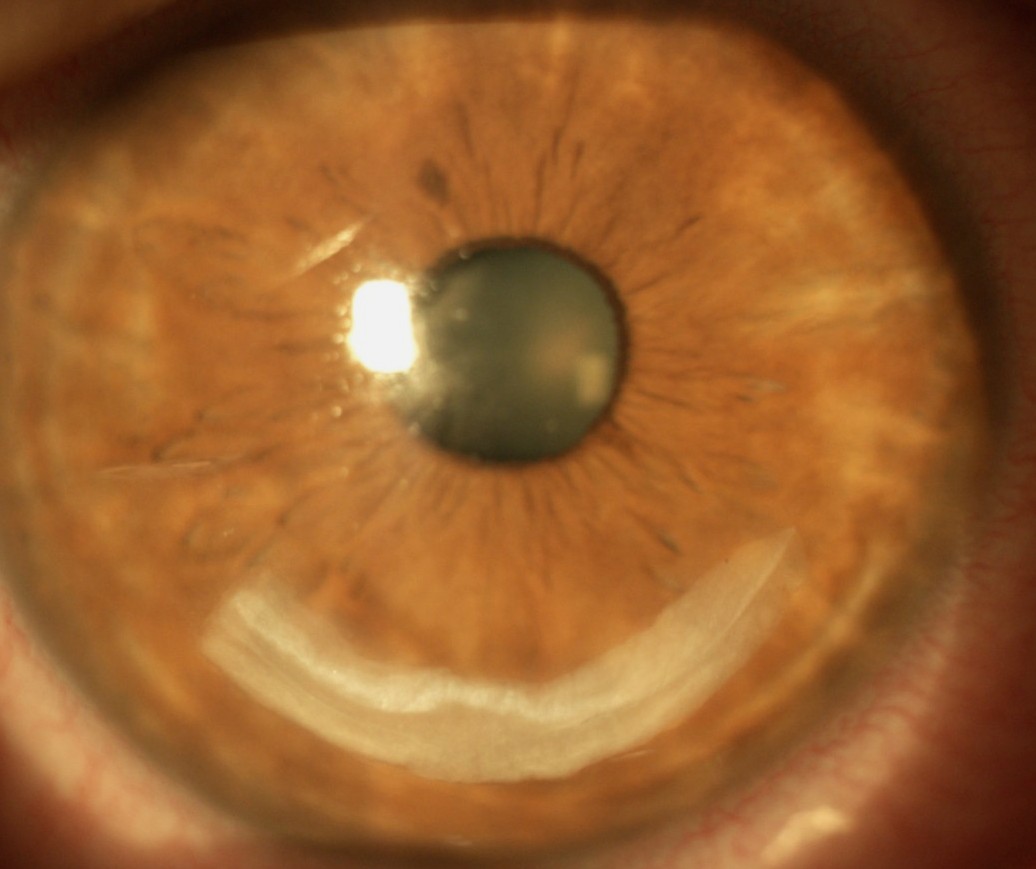 Close-up slit-lamp image of a keratoconus eye showing an intrastromal corneal ring segment (CAIRS, CTAK, Intacs/Ferrara/KeraRing) implanted to reshape the cornea and improve vision