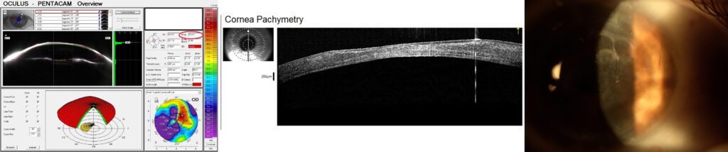 diagram of a cornea