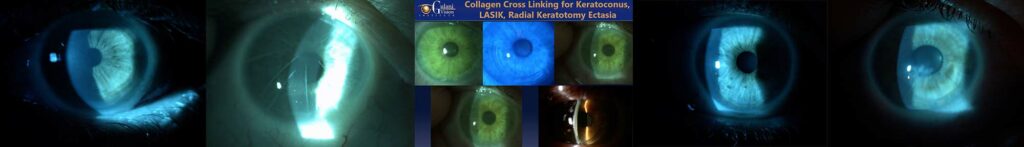 diagram of collagen cross linking of an eye