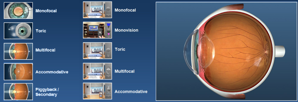 An in-depth diagram of RLE Surgery