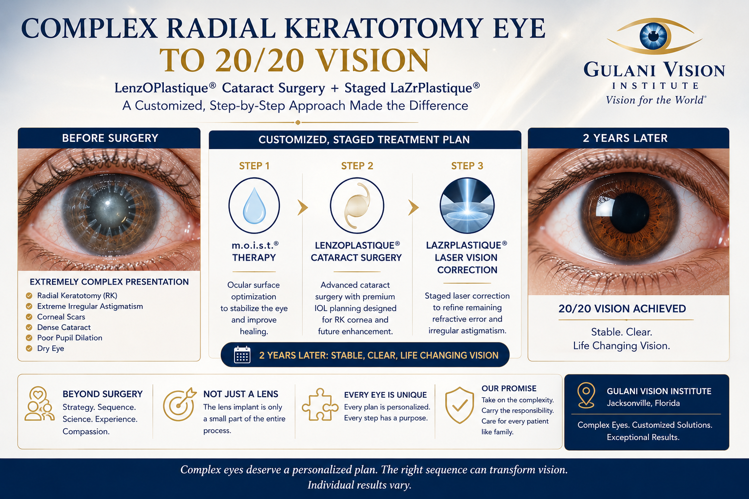 Complex Radial Keratotomy eye with extreme irregular astigmatism, corneal scars, dense cataract, poor pupil dilation and dry eye treated with m.o.i.s.t.® therapy, LenzOPlastique® cataract surgery and staged LaZrPlastique® laser vision correction, with 20/20 vision still maintained at two years.