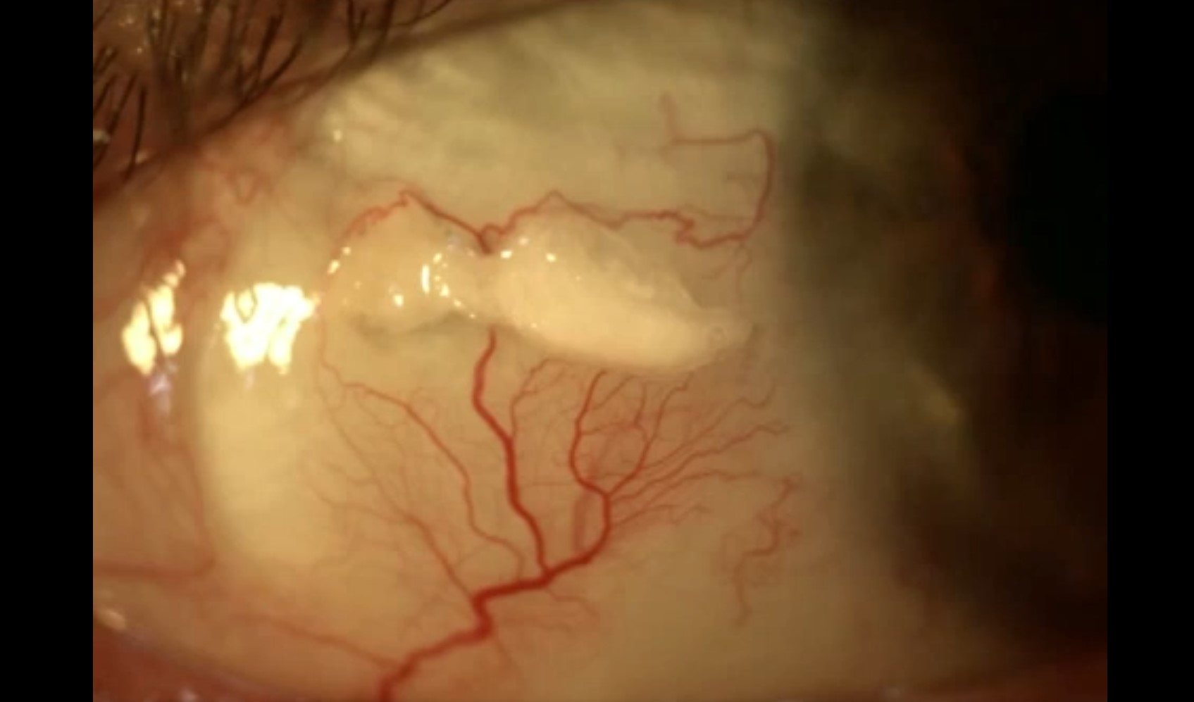 Repairing Scleral Melt