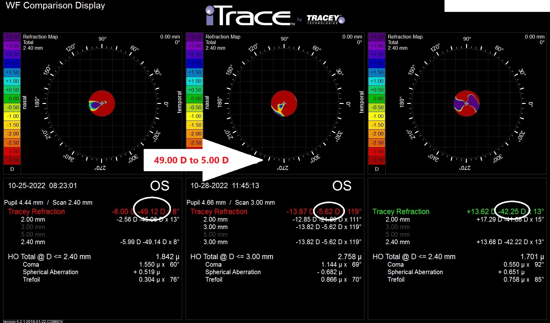 Before-and-after Tracey Analyzer results showing extreme irregular astigmatism reduced from -49.12 diopters to -5.62 diopters during Tracey Tuesday at Gulani Vision Institute.