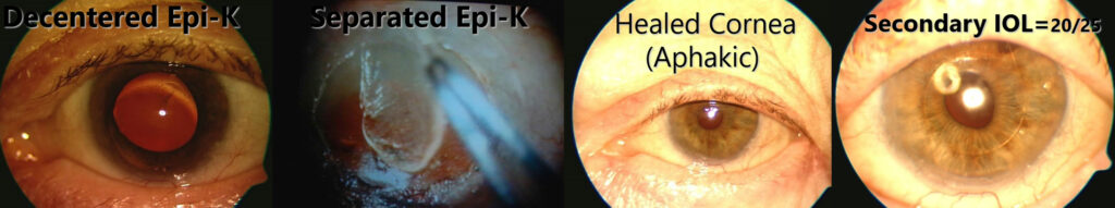 Decentered Epi-K, Separated Epi-K, Healed Cornea (Aphakic) & Secondary IOL=20/25