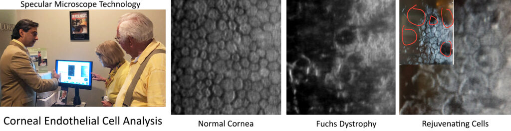 Specular Microscope Technology Corneal Endothelial Cell Analysis