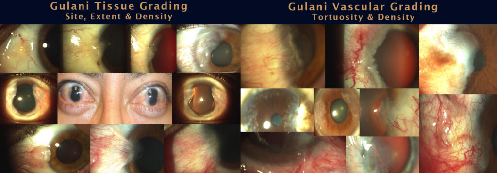 Gulani Tissue Grading (Site, Extent & Density) & Gulani Vascular Grading (Tortuosity & Density)