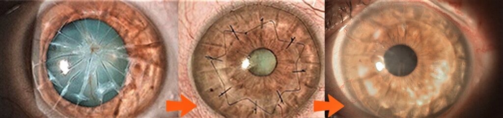 Staging "Impossible" to Vision: Blinding corneal scar to Anterior Lamellar Keratoplasty to Premium Cataract Surgery to 20/20.