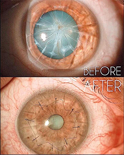 An eye before and after surgery