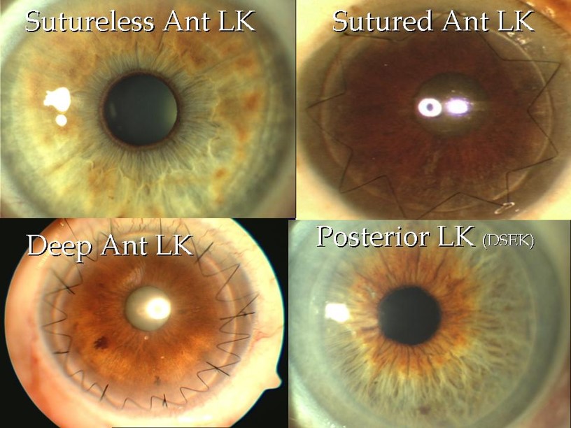 Sutureless Ant LK, Sutured Ant LK, Deep Ant LK, Posterior LK (DSEK)