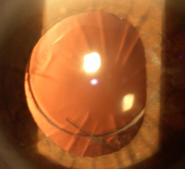 Slit-lamp photograph of a Light Adjustable Lens® (RxSight® LAL®) implanted in an eye with previous Radial Keratotomy (RK) incisions, demonstrating that while the premium intraocular lens provides adjustable refractive power, pre-existing corneal irregularity and altered optics continue to influence visual quality after cataract surgery.