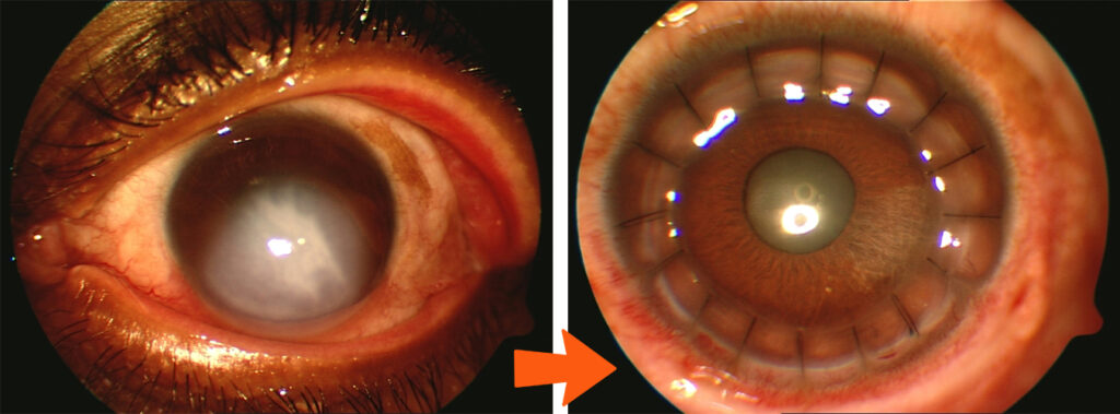 PKP - Penetrating Keratoplasty