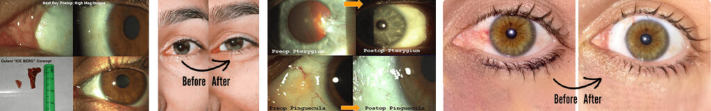 before and after photo of pinguecula eye surgery