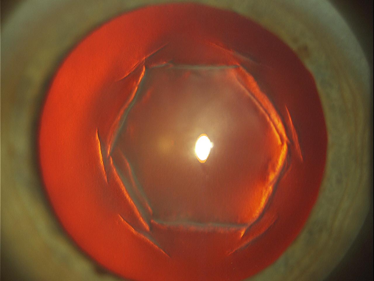 Slit-lamp retroillumination image showing a cornea with previous Hexagonal Keratotomy incisions causing irregular corneal optics, visual distortion, glare, halos, and cataract-related vision complications.