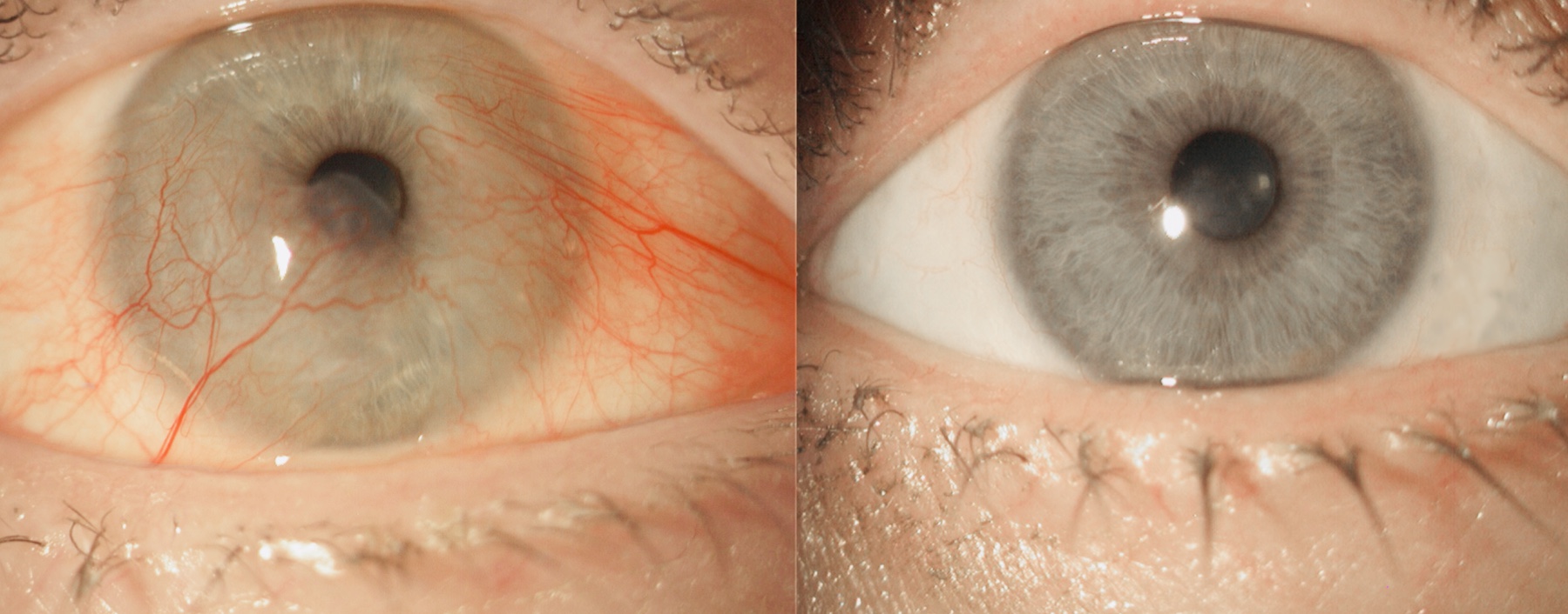 Before and after cosmetic pterygium surgery showing red eyes restored to clear, white eyes.”