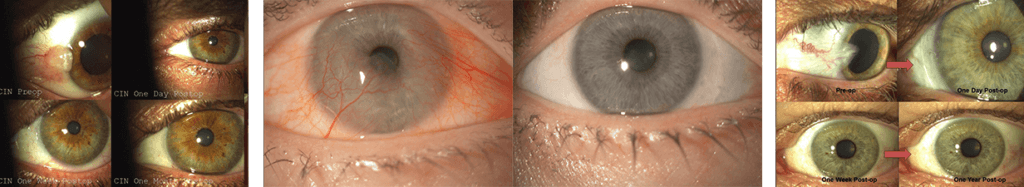 Pre-Operative and Post-Operative images of Gulani SPARKLE™ Technique for Pterygium. 