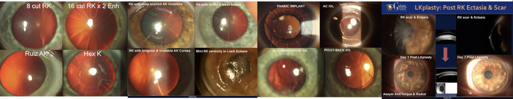 close up photo of an eye with blinding radial keratotomy scars