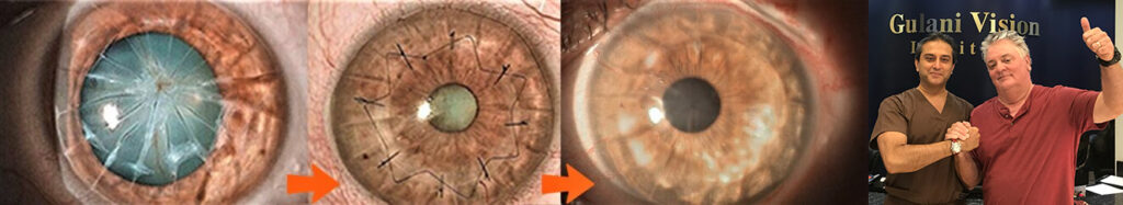 individual patient and ophthalmologist after radial keratotomy surgery