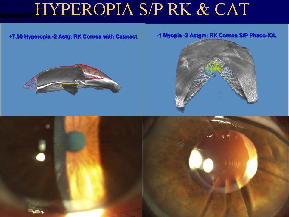 Hyperopia S/P RK and CAT Chart