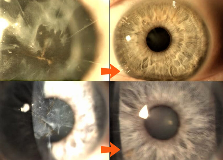 diagram of four different corneas